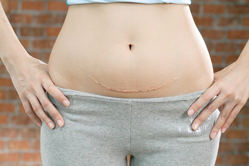 Đối tượng phù hợp với sửa sẹo xấu sau sinh vùng kín