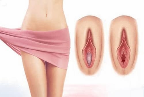 Tái Tạo Màng Trinh An Toàn, Hiệu Quả Giúp Lấy Lại Sự Tự Tin - Ảnh 2