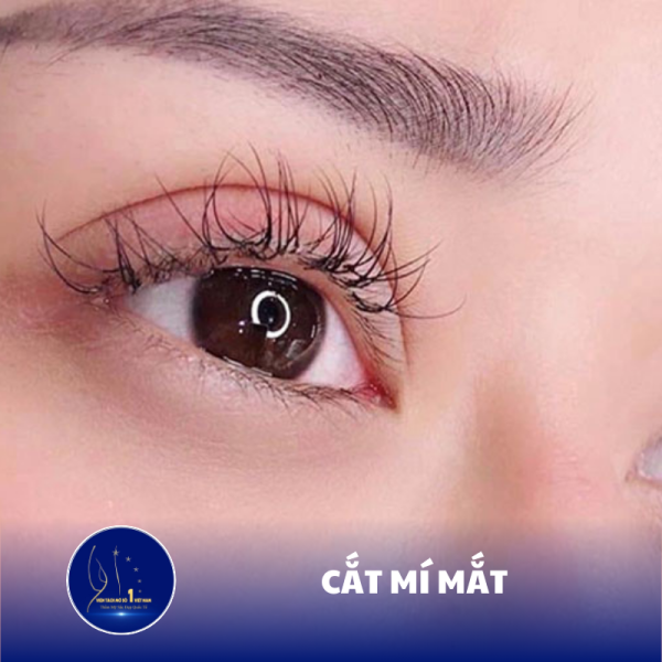 Cắt Mí Mắt An Toàn Nhanh Chóng Cho Đôi Mắt Cuốn Hút Tại Viện Tách Mỡ Số 1 Việt Nam