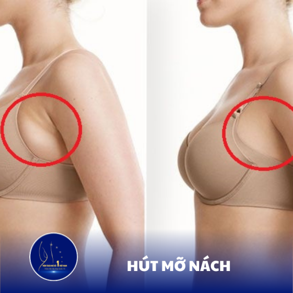 Giải Quyết Mỡ Nách Nhanh Chóng Với Công Nghệ Hút Mỡ Tiên Tiến