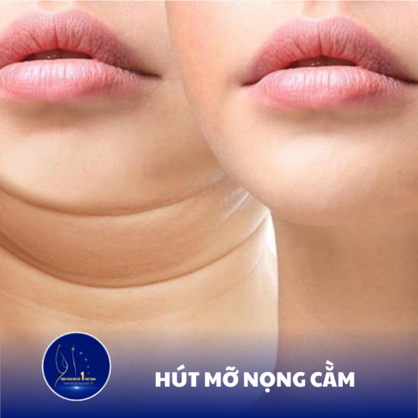 Hút Mỡ Nọng Cằm: Giải Pháp An Toàn và Hiệu Quả Tại Viện Tách Mỡ Số 1 Việt Nam