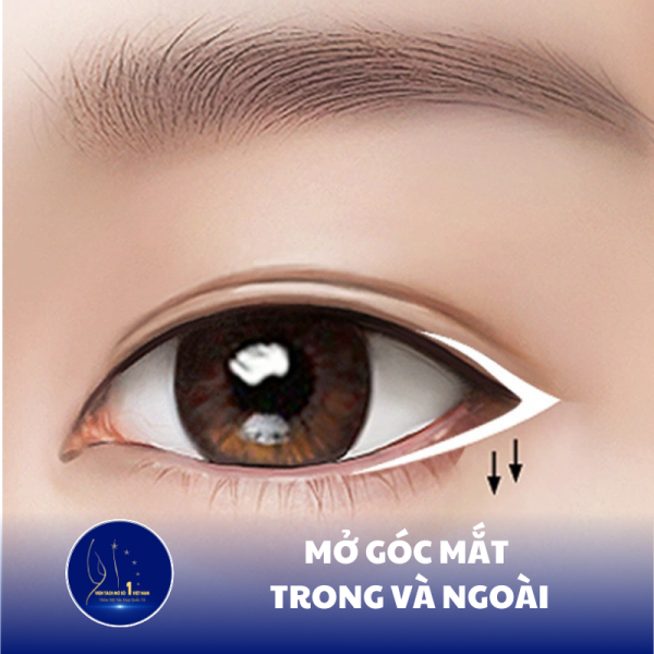 Mở Góc Mắt Trong Và Ngoài: Cải Thiện Vẻ Đẹp Tinh Tế Cho Đôi Mắt