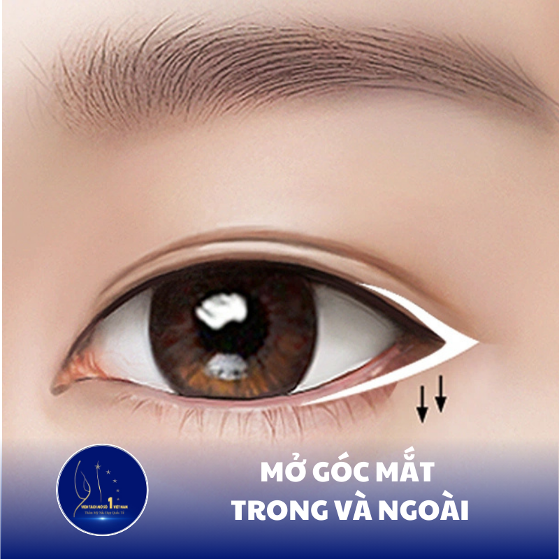 Mở Góc Mắt Trong Và Ngoài: Cải Thiện Vẻ Đẹp Tinh Tế Cho Đôi Mắt