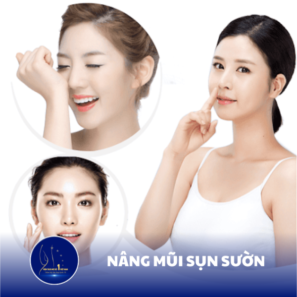 Công Nghệ Nâng Mũi Sụn Sườn: Tự Nhiên, Bền Vững Tại Viện Tách Mỡ Số 1 Việt Nam