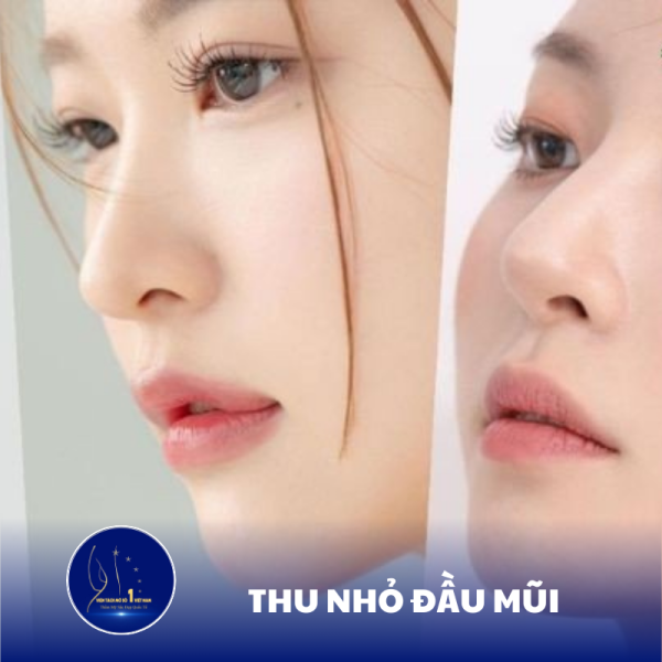 Sở Hữu Đầu Mũi Thon Gọn Tại Viện Tách Mỡ Số 1 Việt Nam