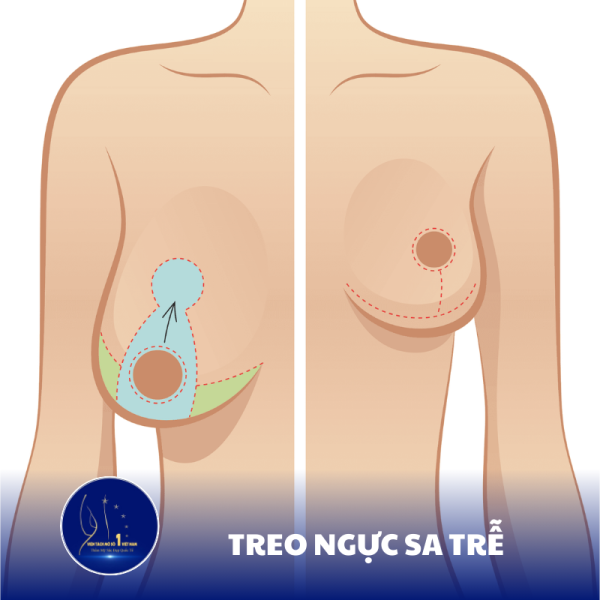 Treo Ngực Sa Trễ: Lấy Lại Vòng 1 Thon Gọn Và Quyến Rũ