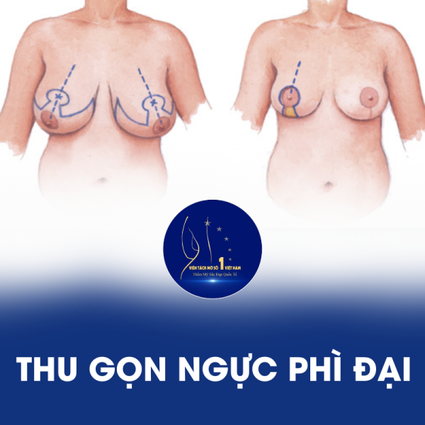 Thu Gọn Ngực Phì Đại: Lấy Lại Vòng 1 Săn Chắc, Cân Đối Tại Viện Tách Mỡ Số 1 Việt Nam