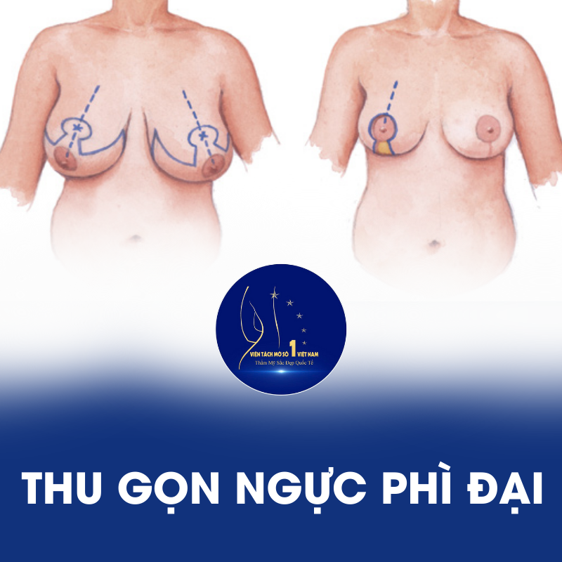 Thu Gọn Ngực Phì Đại: Lấy Lại Vòng 1 Săn Chắc, Cân Đối Tại Viện Tách Mỡ Số 1 Việt Nam