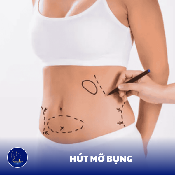 Lấy Lại Vòng Eo Lý Tưởng Với Quy Trình Hút Mỡ Bụng An Toàn Và Hiệu Quả