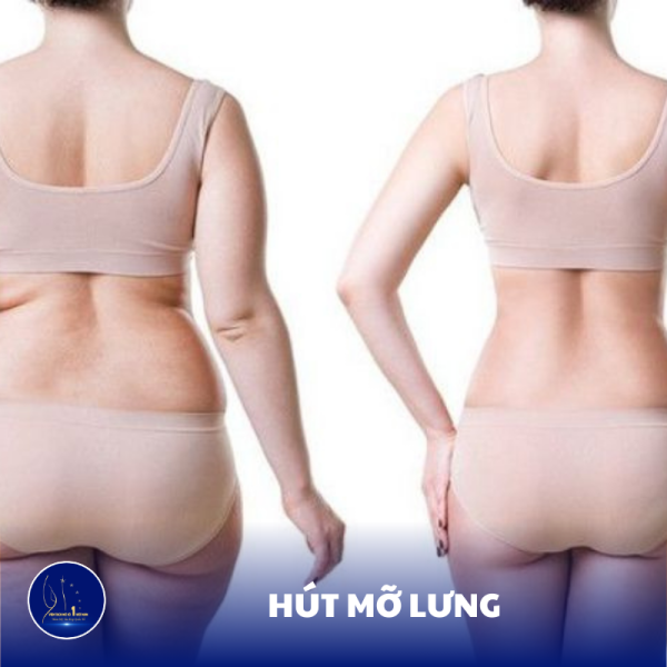 Giải Quyết Nỗi Lo Mỡ Thừa Ở Lưng Với Phương Pháp Hút Mỡ Hiện Đại