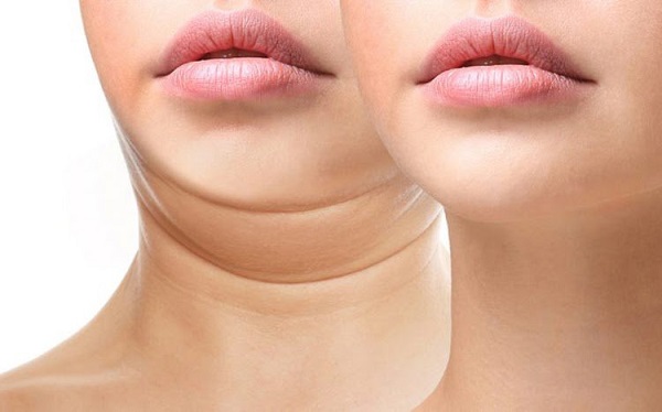 Công Nghệ Hút Mỡ Nọng Cằm Tại Viện Tách Mỡ Số 1 Việt Nam