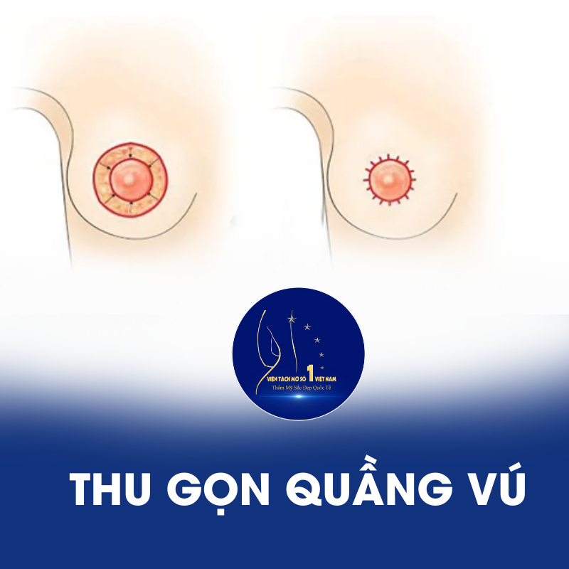 Thu Gọn Quầng Vú: Giải Pháp Tinh Tế Cho Vòng 1 Quyến Rũ