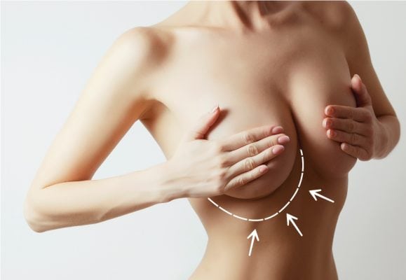 Kết quả phẫu thuật treo ngực duy trì bao lâu?