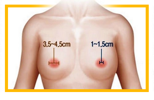 Công nghệ thu gọn quầng vú tại Viện Tách Mỡ Số 1 Việt Nam