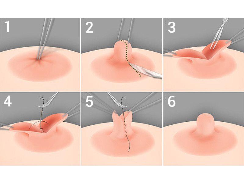 Đối tượng phù hợp với phẫu thuật thu nhỏ núm vú